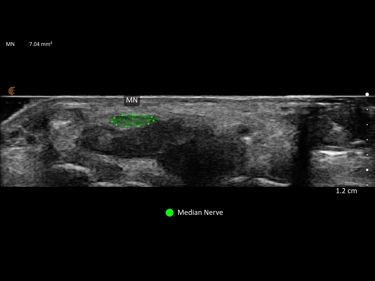 Illustration officielle de Median Nerve AI